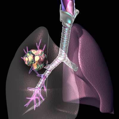 El cáncer de pulmón es el segundo cáncer más frecuente en Venezuela