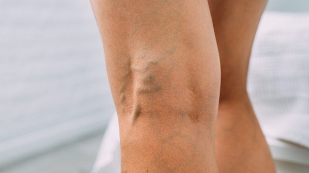 Tipos de varices que son y como quitarlas