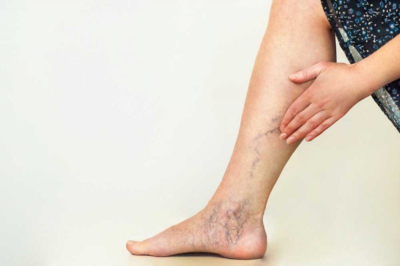 Venas varicosas